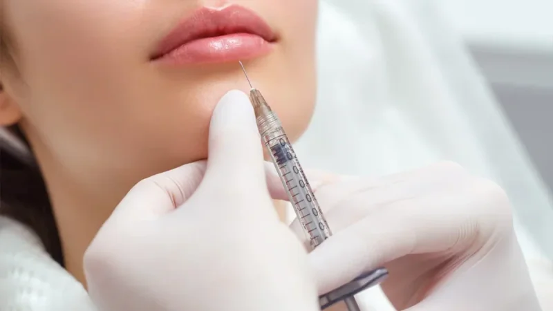 Lip Filler, the Subtle Way